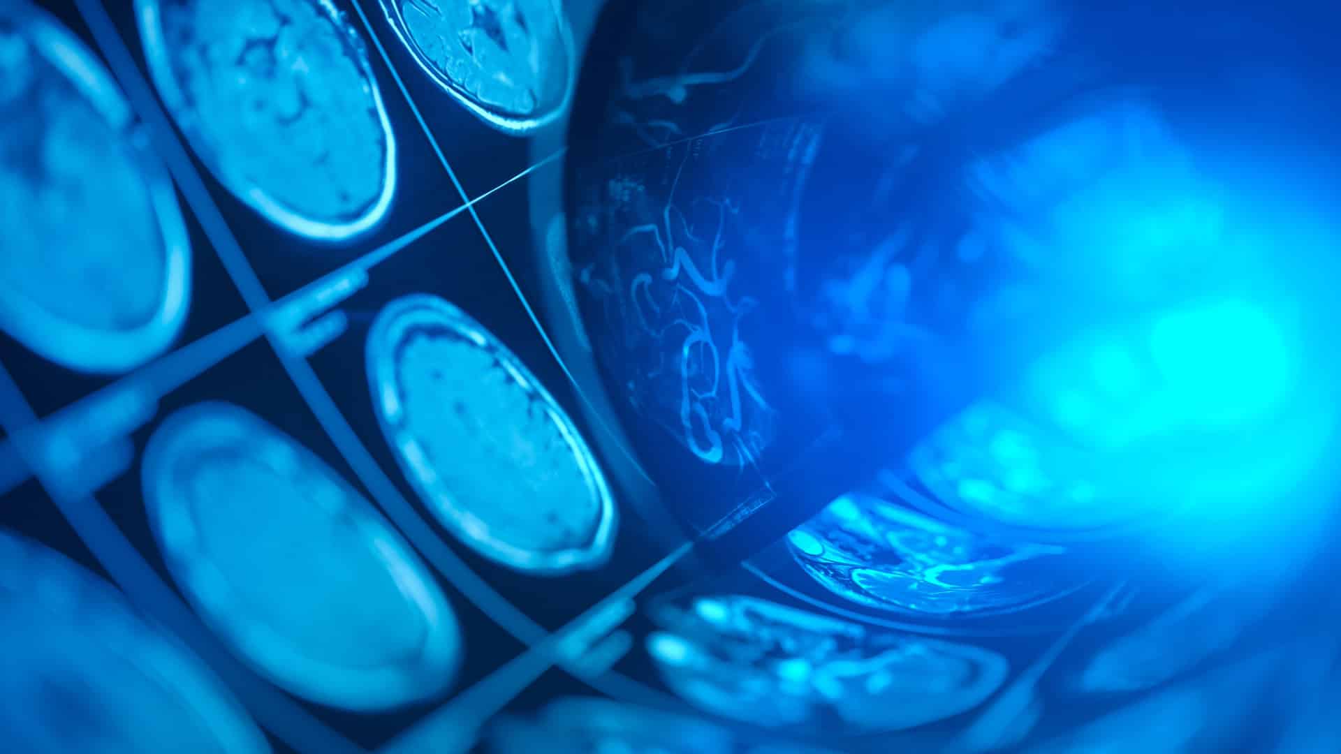 Blue tinted brain scans to depict medical trauma that can lead to the need for medical trauma therapy.